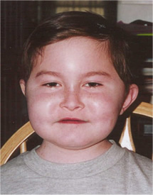 Matthew with Steroid Induced "moon" face
