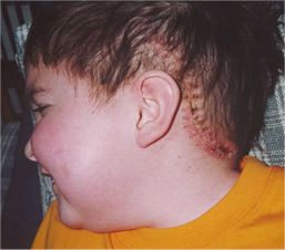 Matthew's sutures scabbing, but still raw (post brain fluid leak)